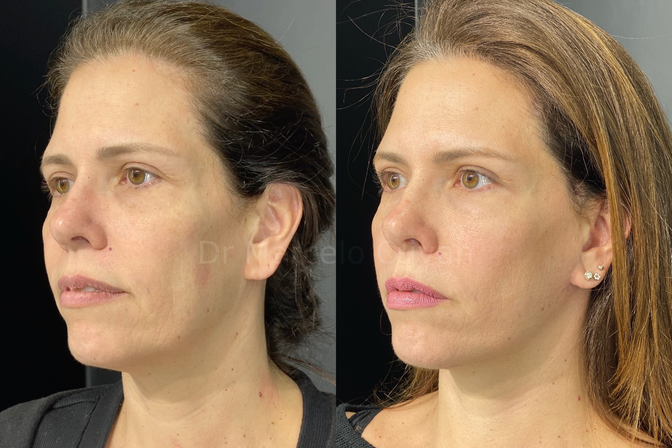 Resultado Daniela - Visão Angular