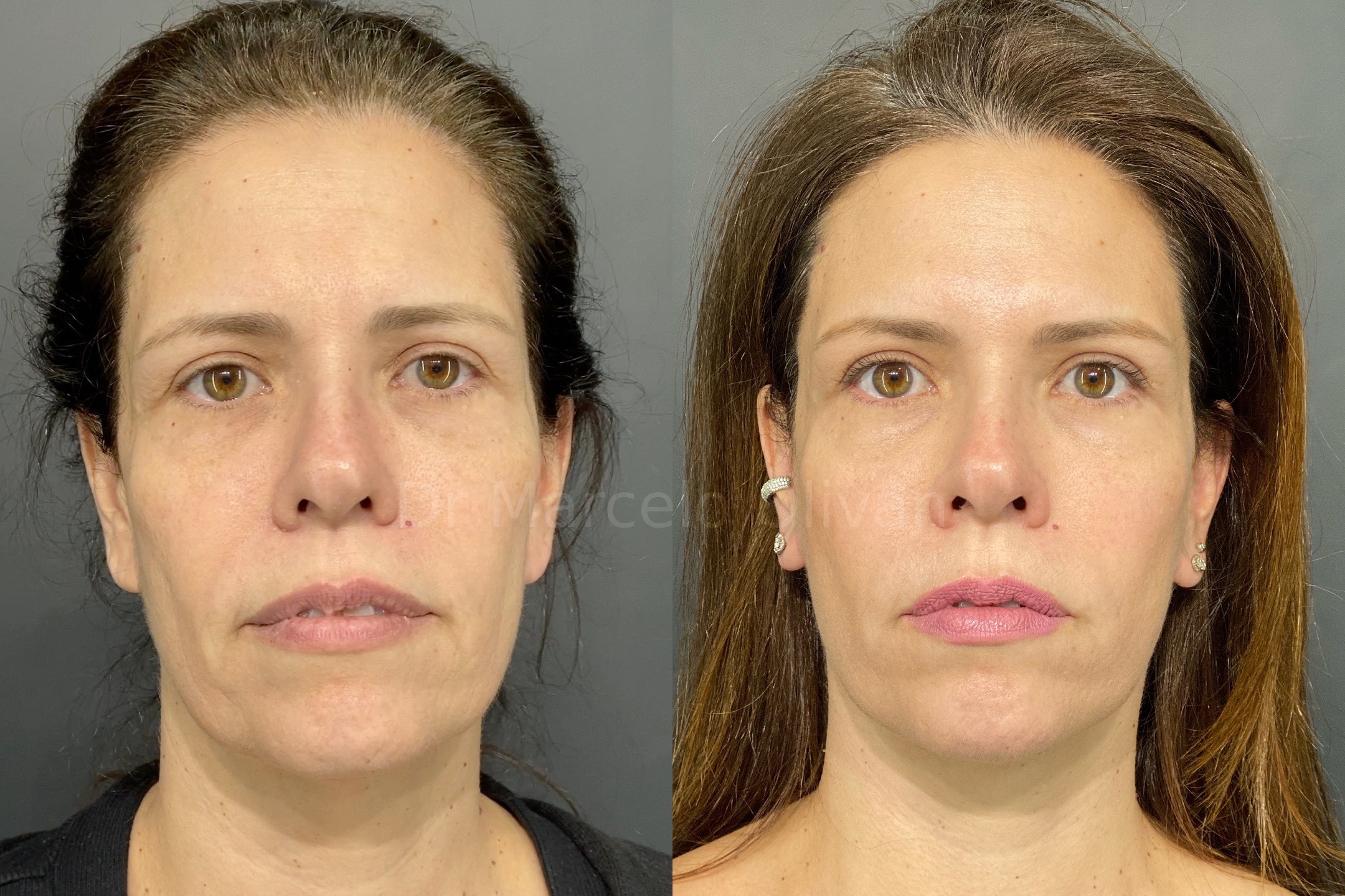 Resultado Daniela - Visão Frontal