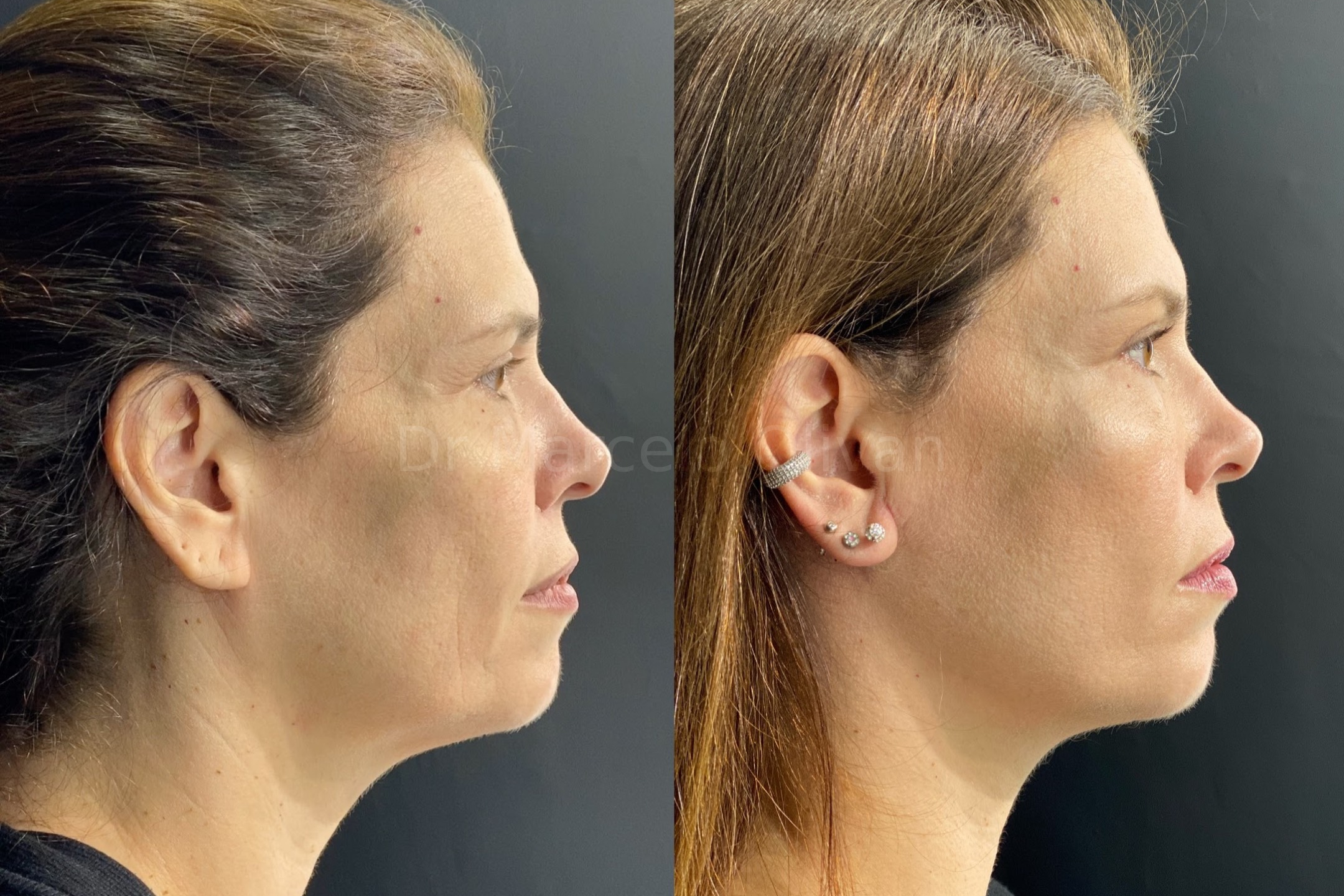 Resultado Daniela - Visão Lateral