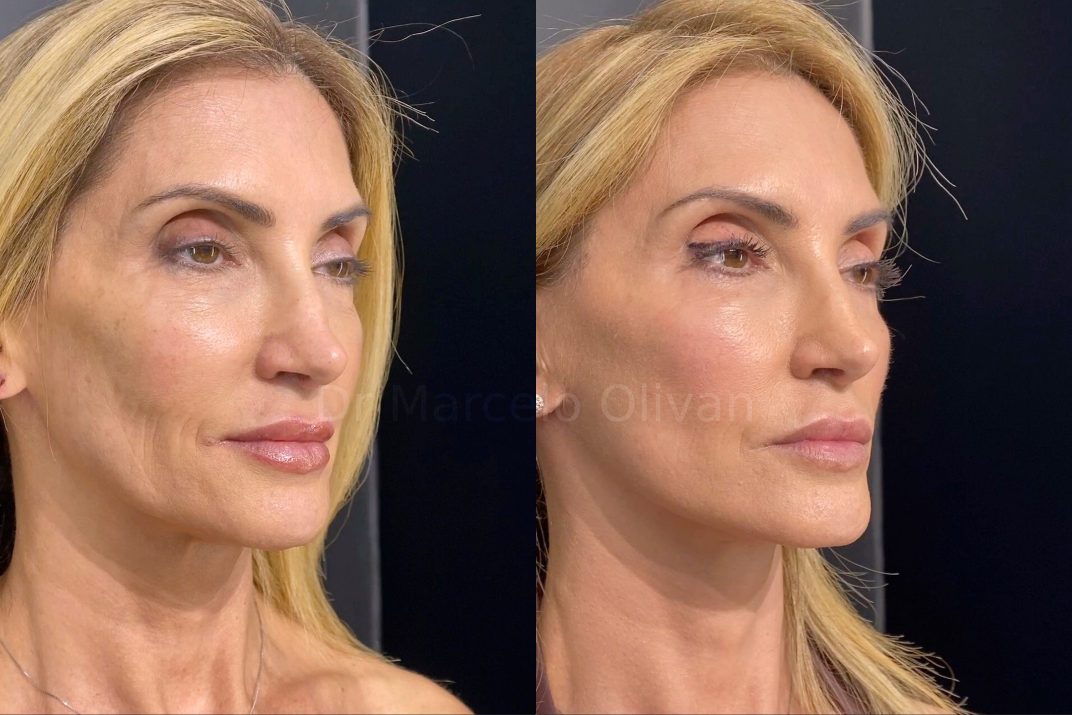 Resultado Gisele - Visão Angular