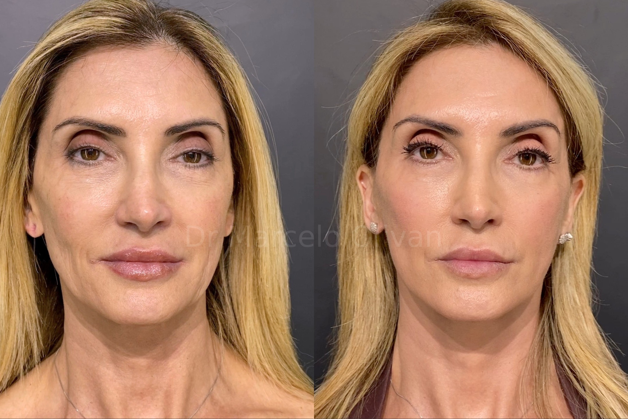 Resultado Gisele - Visão Frontal