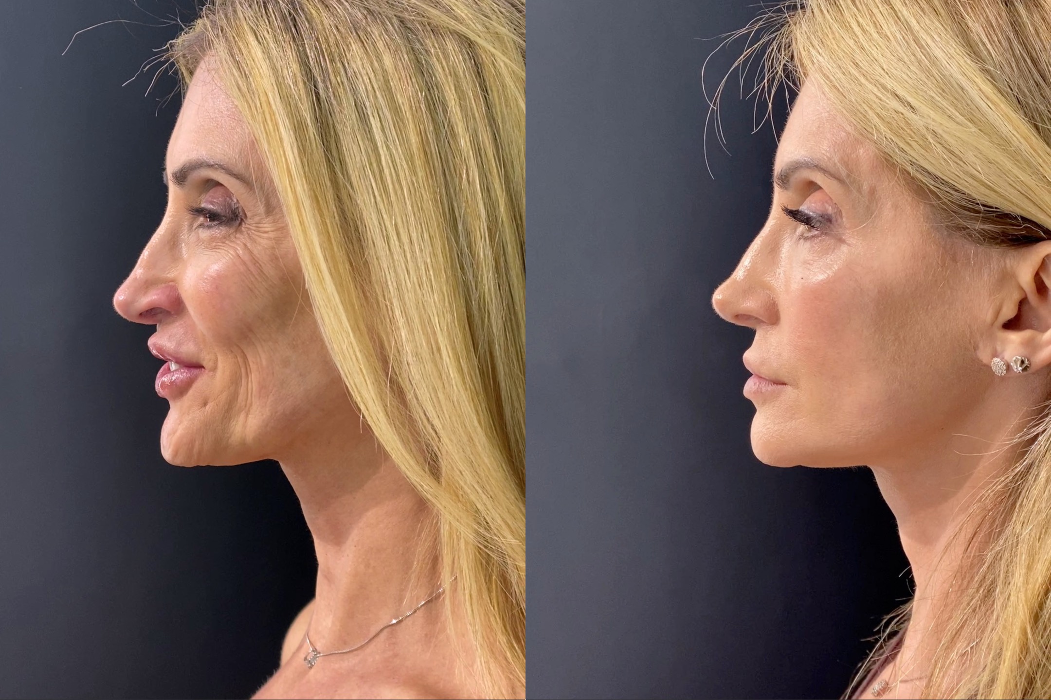 Resultado Gisele - Visão Lateral