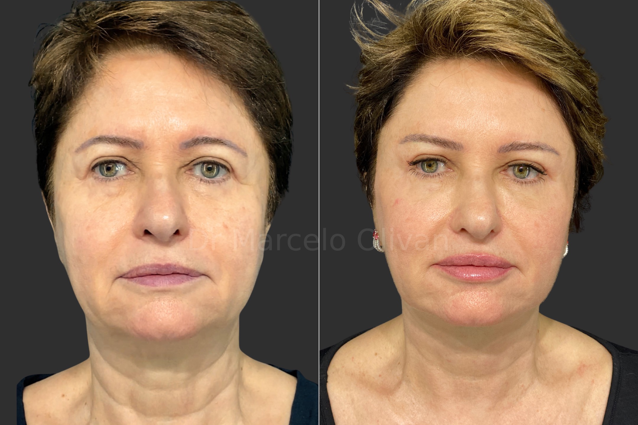 Resultado Ísis - Visão Frontal