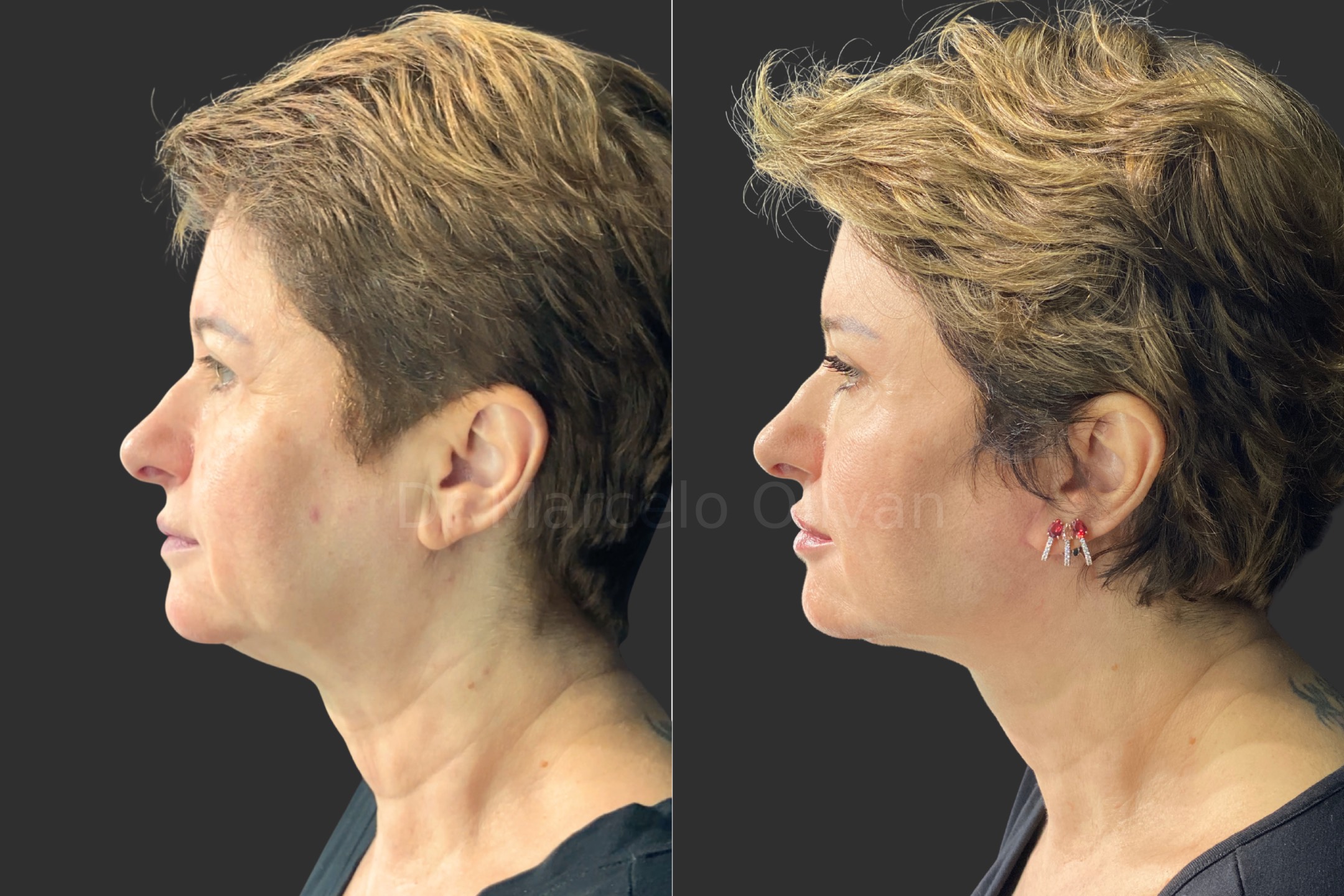 Resultado Ísis - Visão Lateral Esquerda
