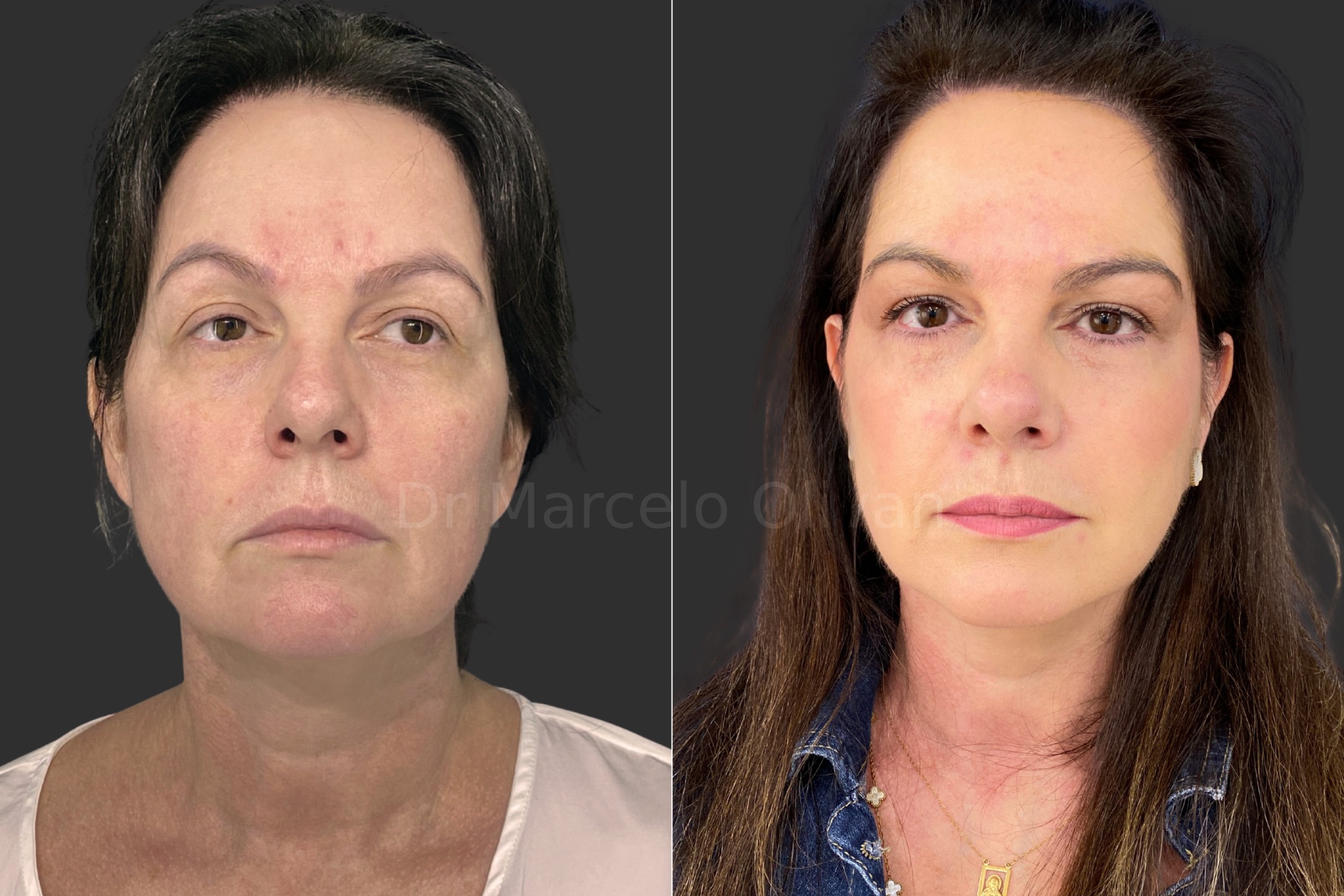 Resultado Roselane - Visão Frontal