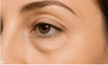 Ilustração anatômica — Blefaroplastia Inferior