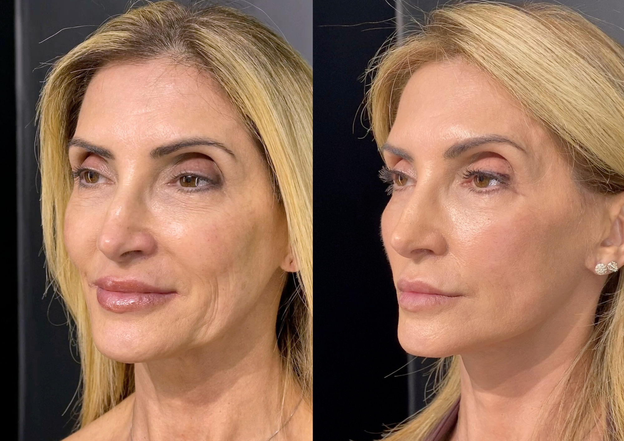 Antes e depois — Frontal