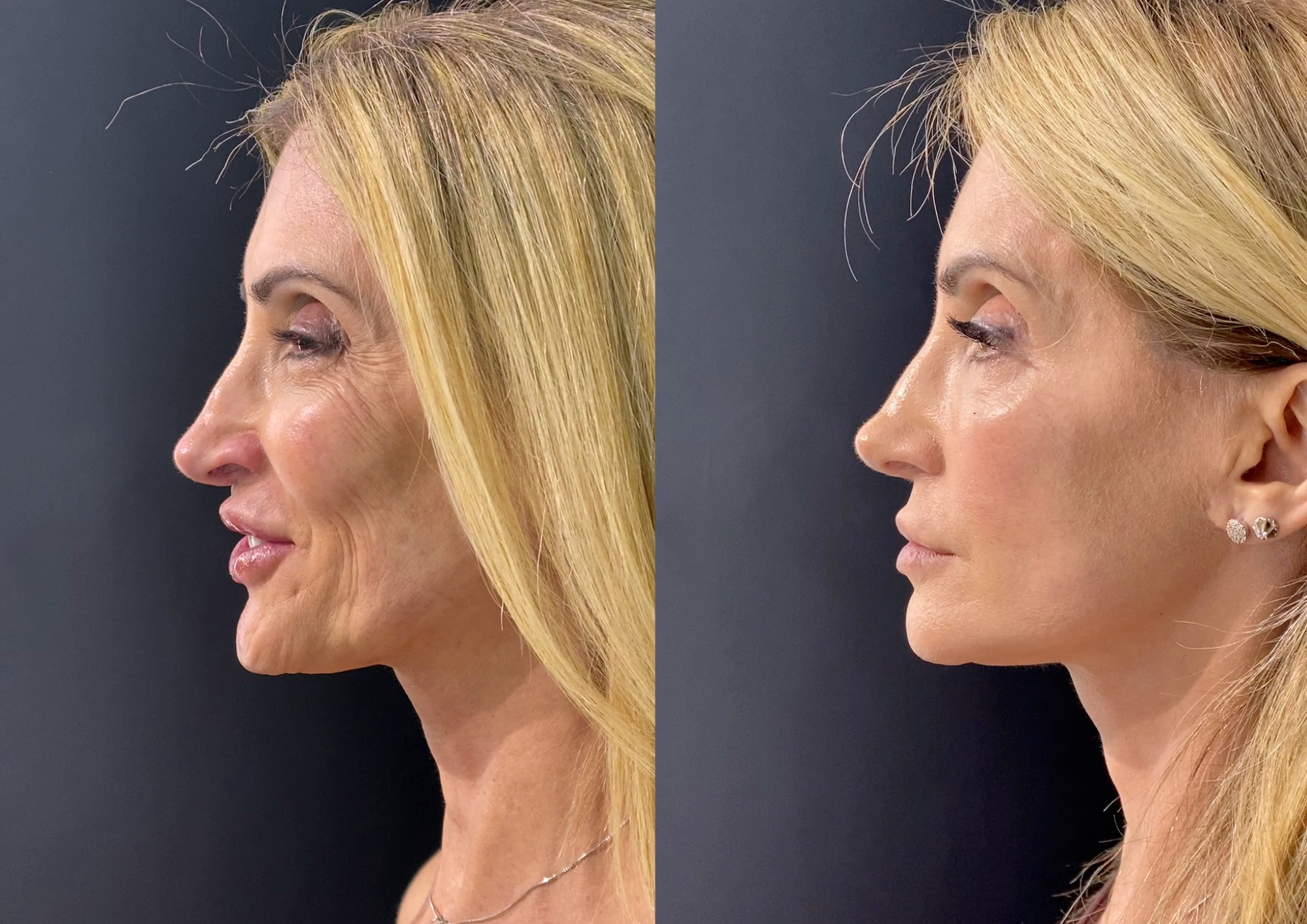 Antes e depois — Perfil direito