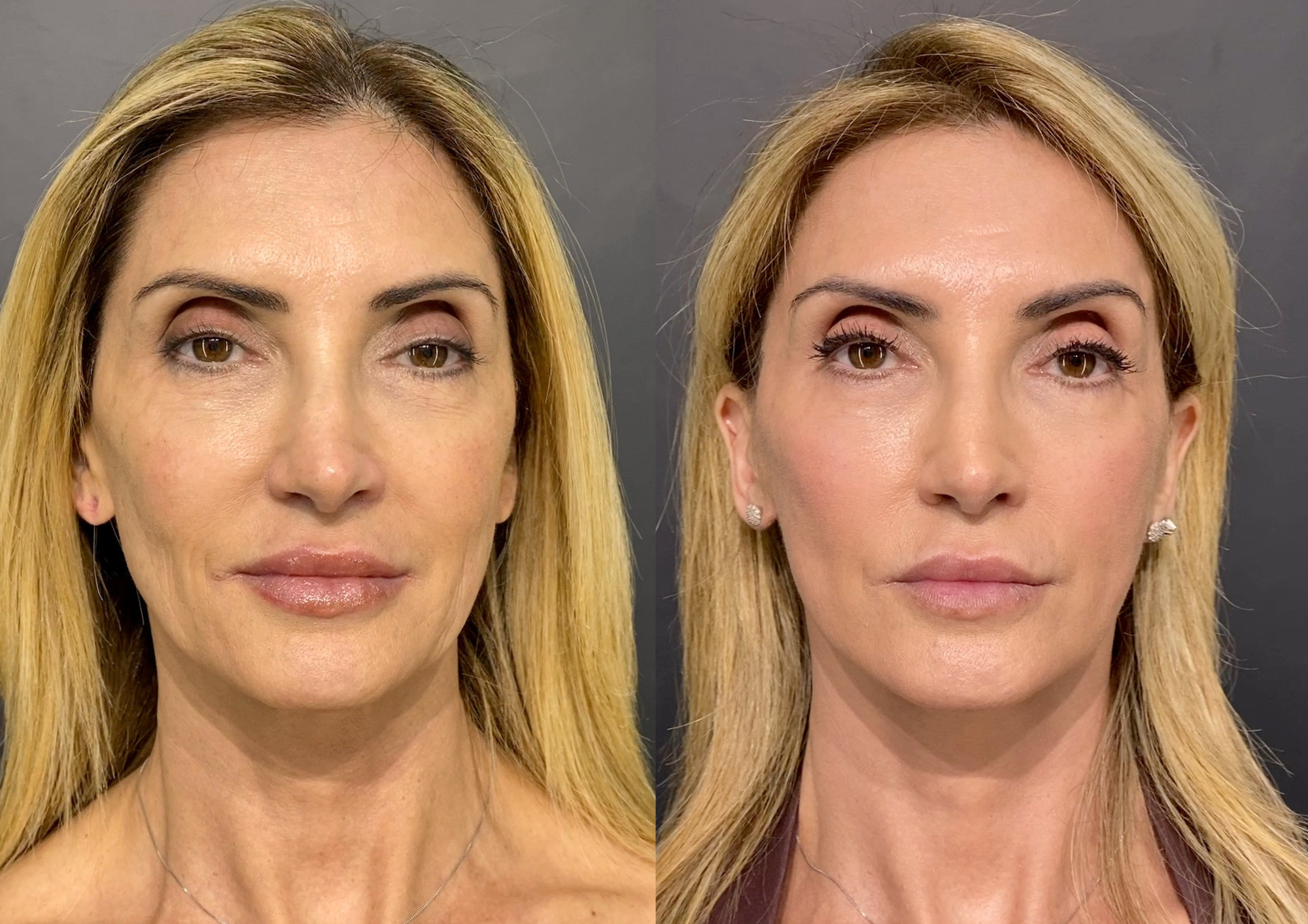 Antes e depois — Perfil esquerdo
