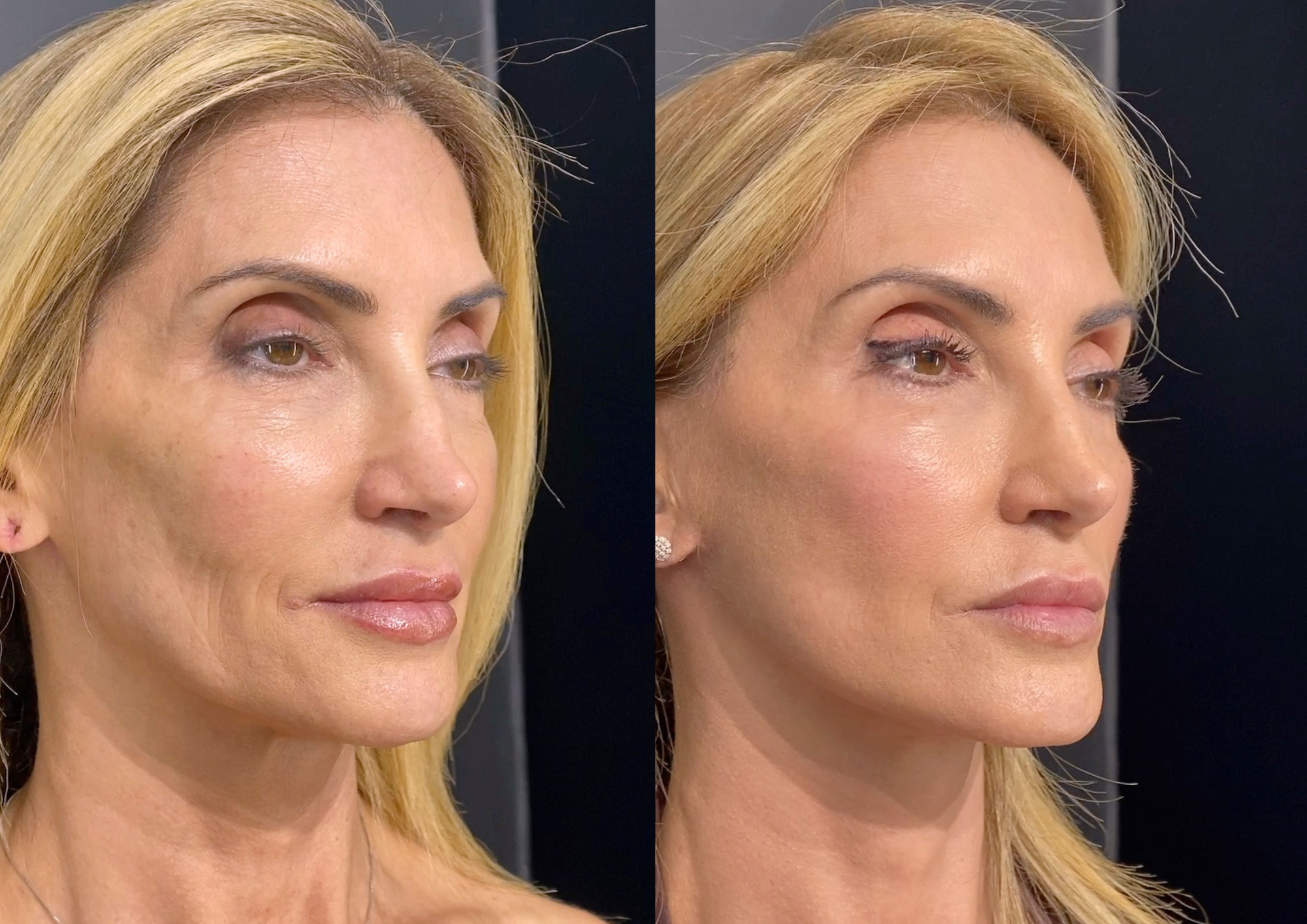 Antes e depois — 45° direita