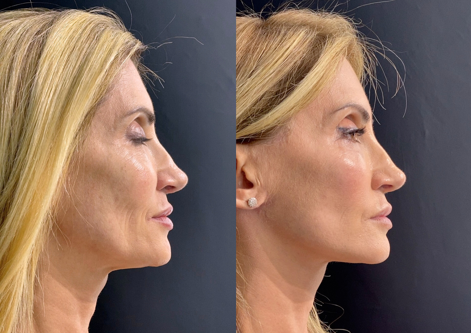 Antes e depois — 45° esquerda