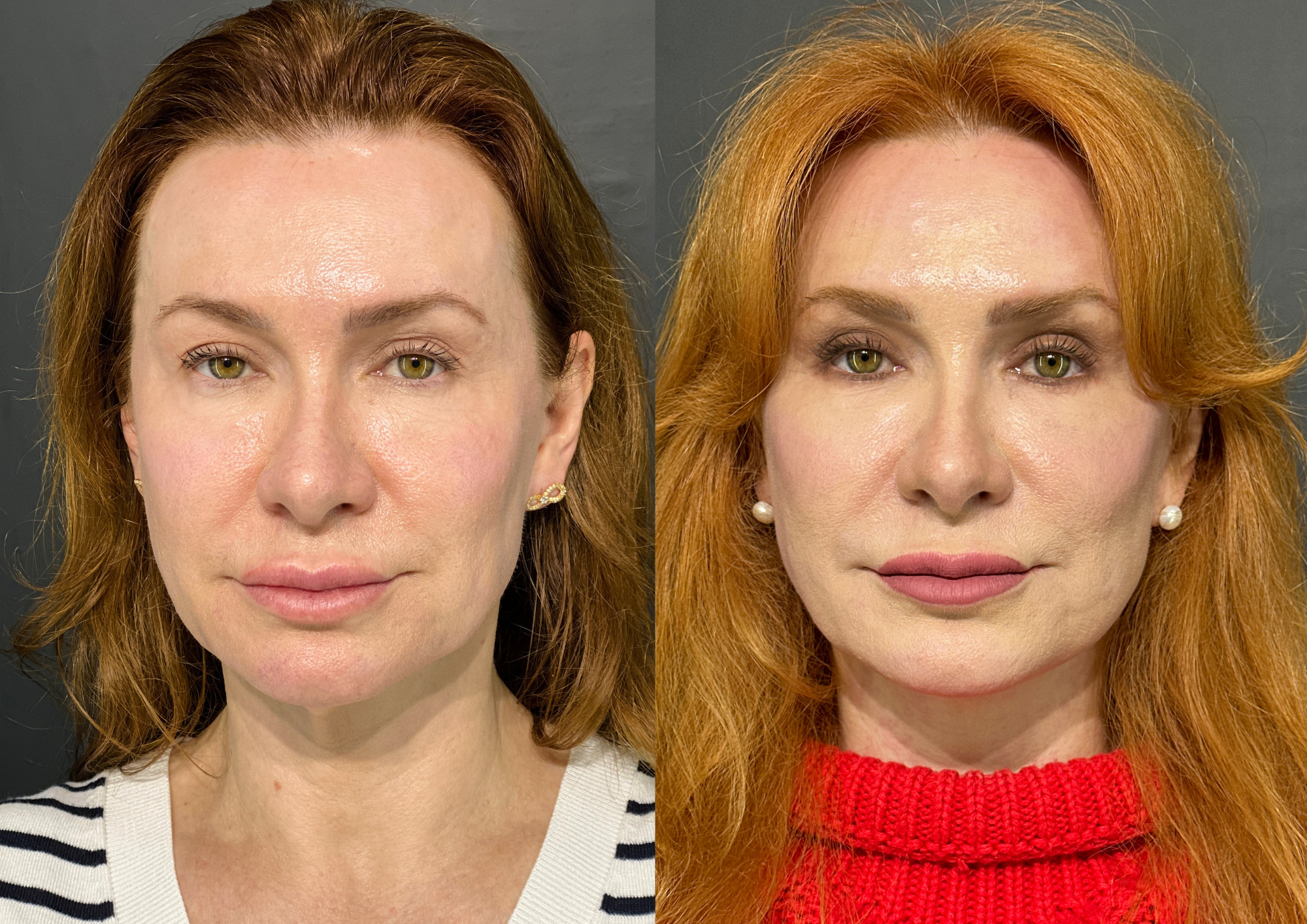 Antes e depois — Frontal
