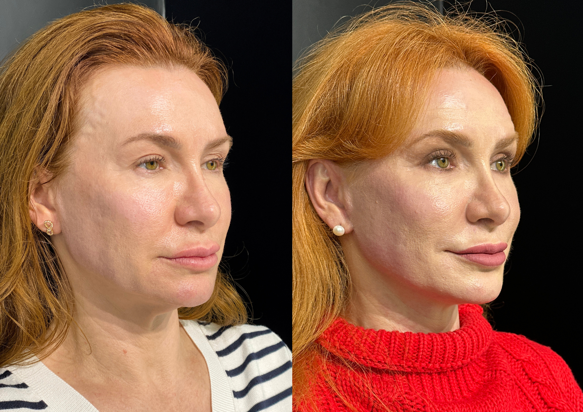 Antes e depois — Perfil direito