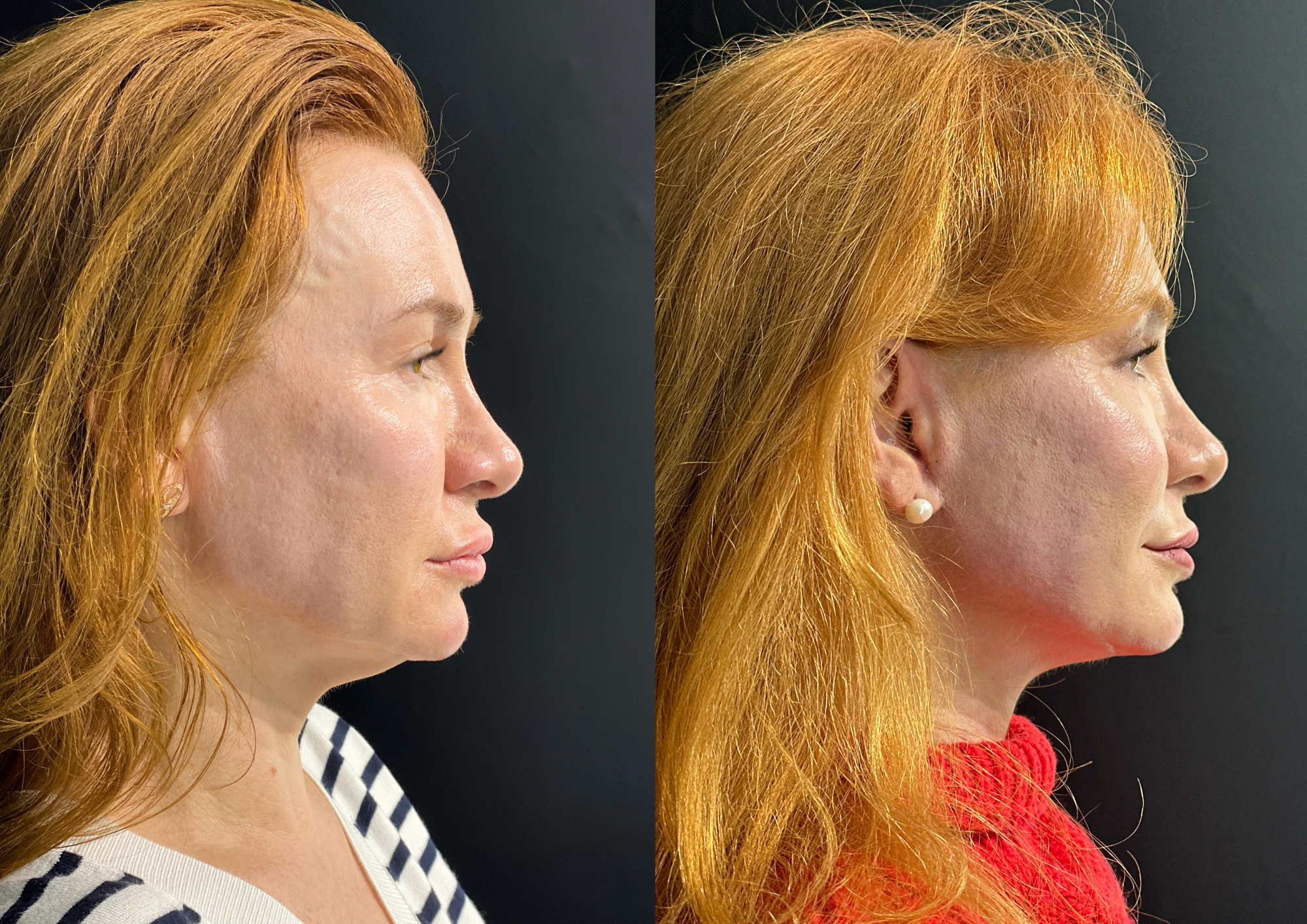 Antes e depois — Perfil esquerdo