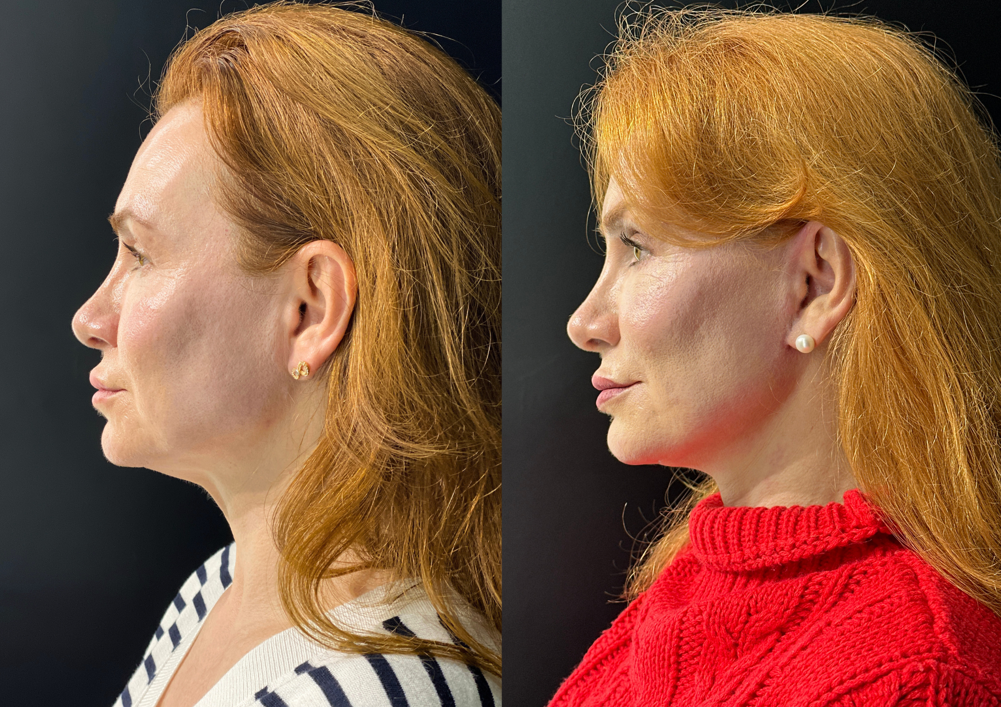 Antes e depois — 45° direita