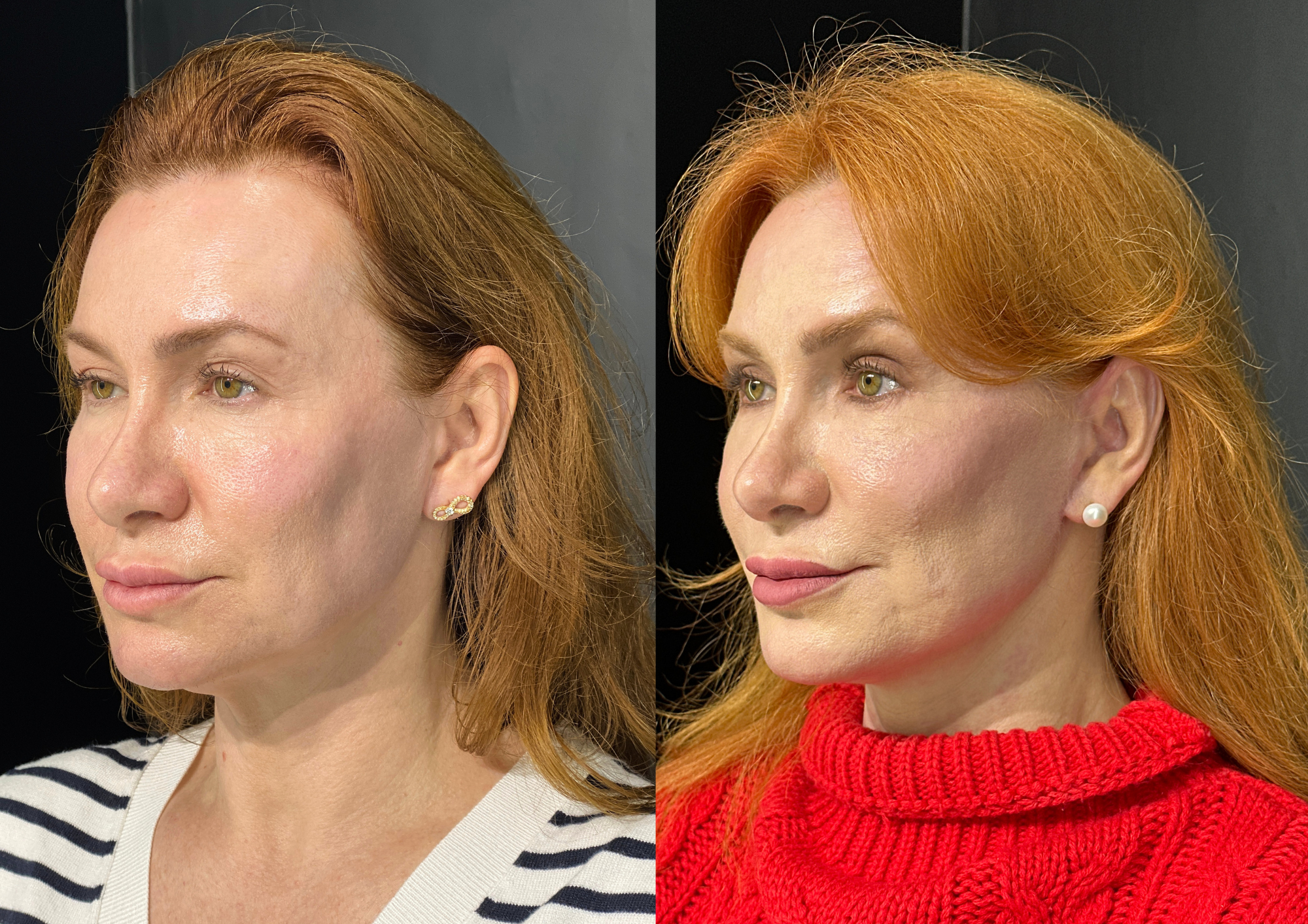 Antes e depois — 45° esquerda