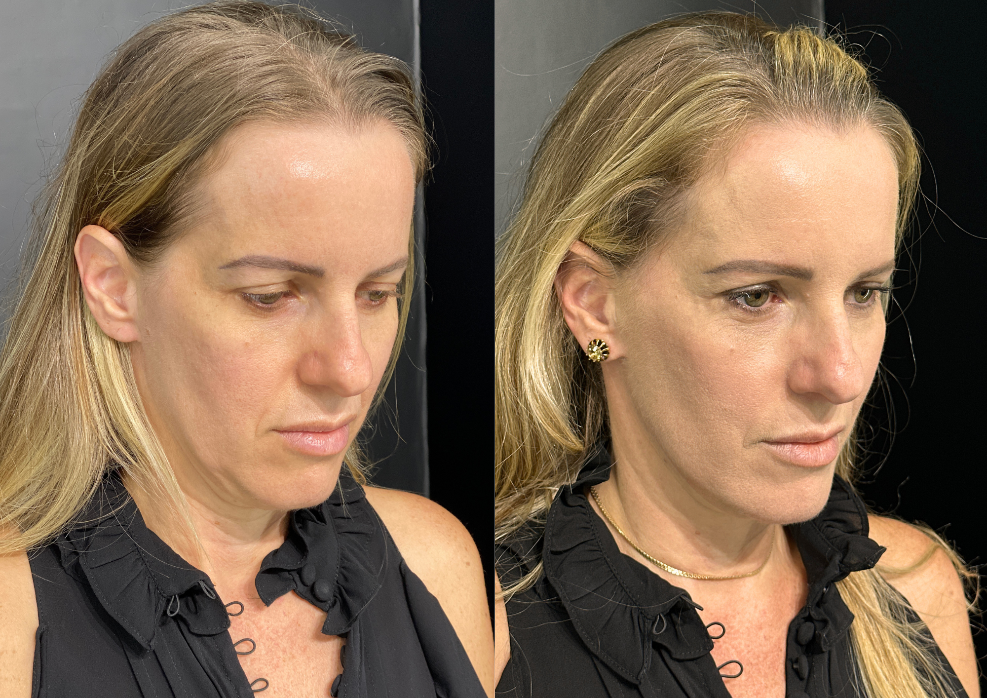 Antes e depois — Frontal
