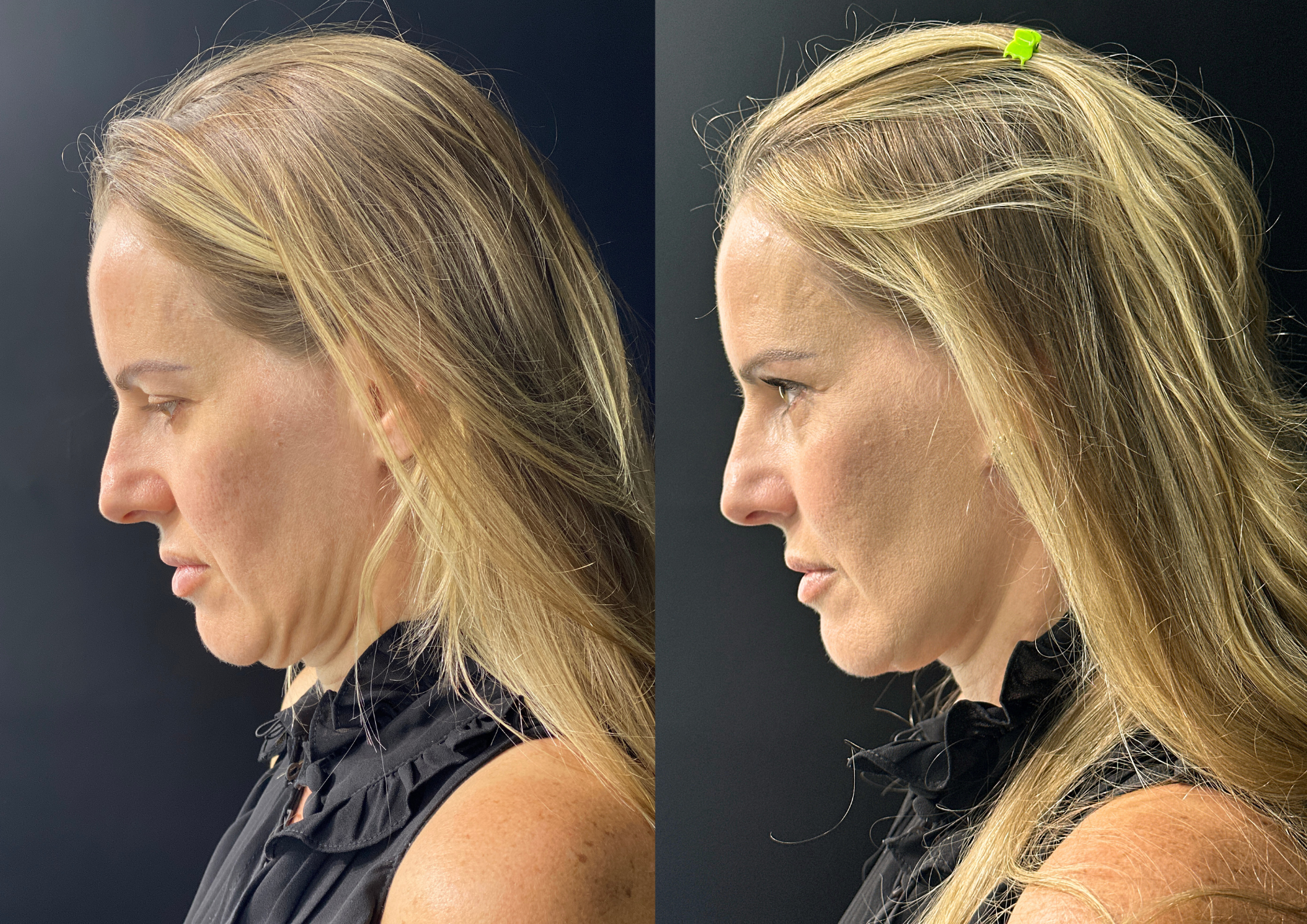 Antes e depois — Perfil direito