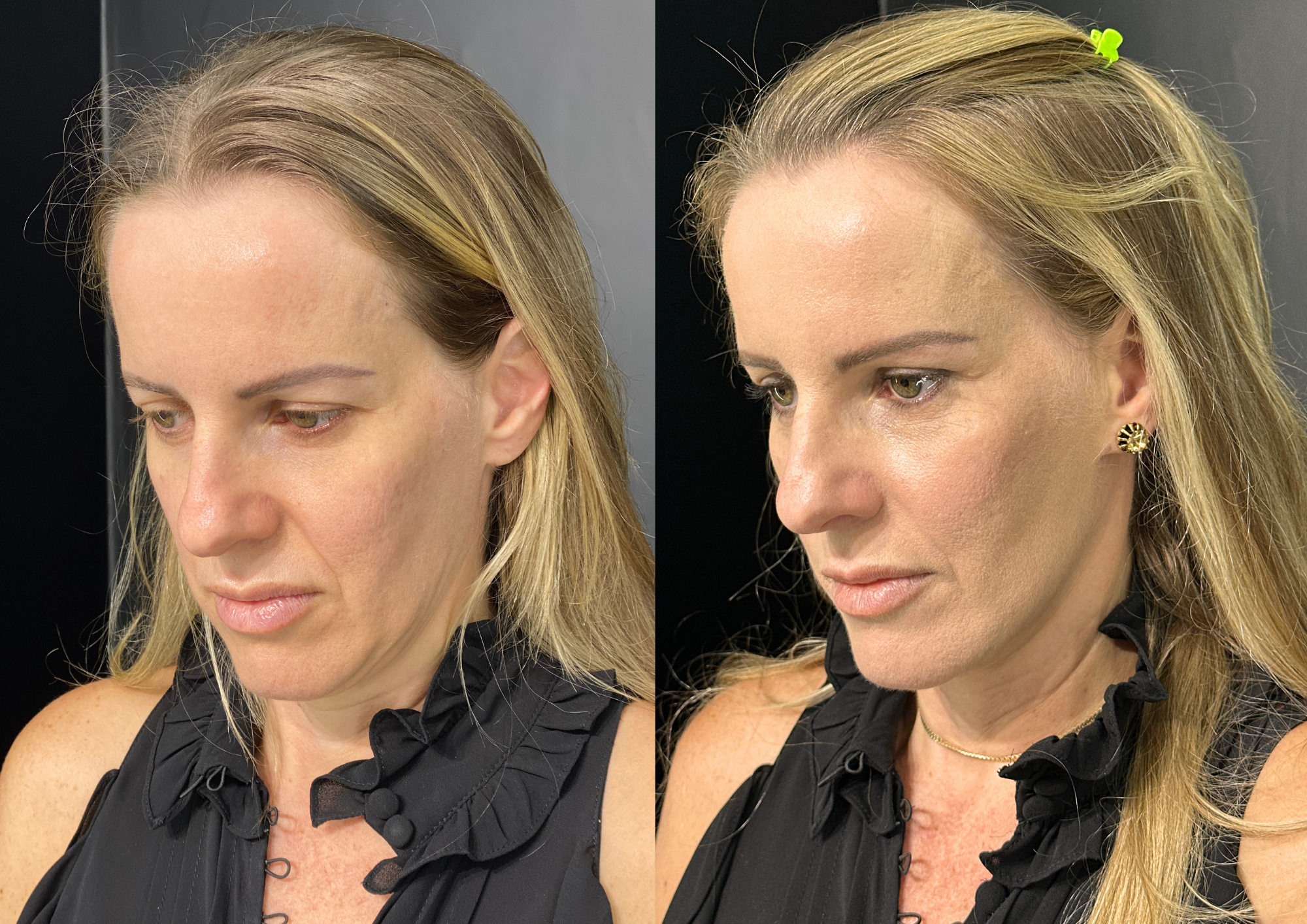 Antes e depois — Perfil esquerdo