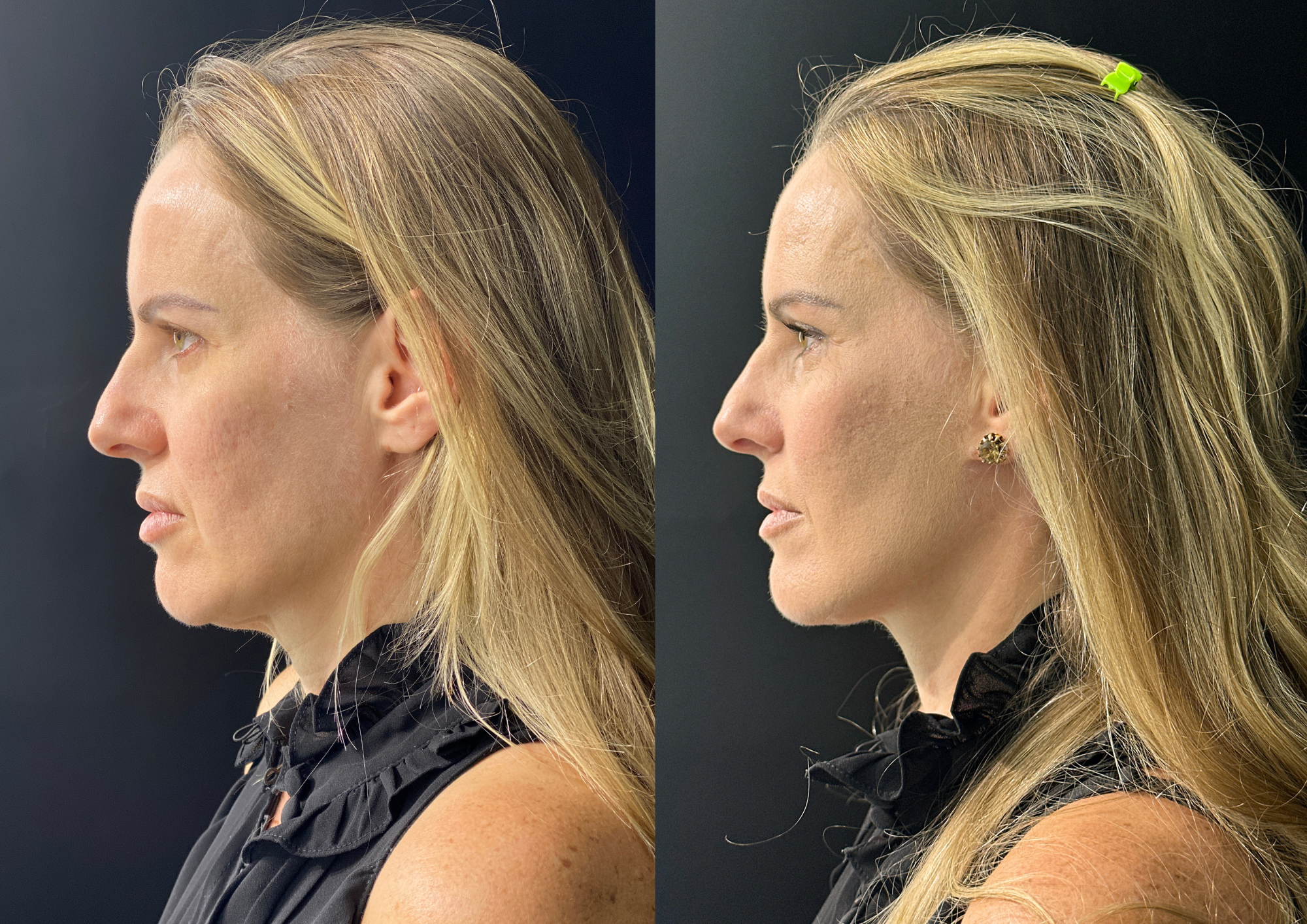 Antes e depois — 45° direita