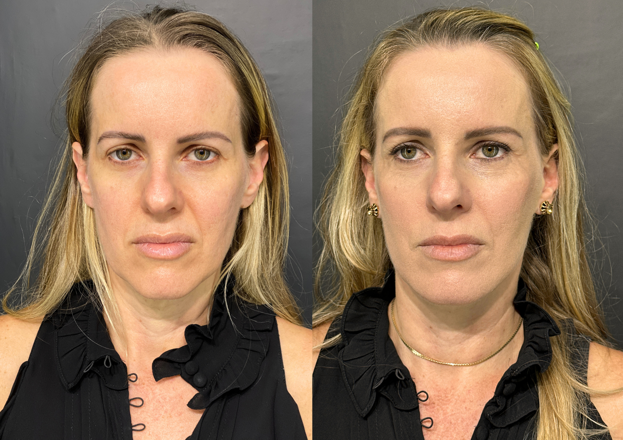 Antes e depois — 45° esquerda
