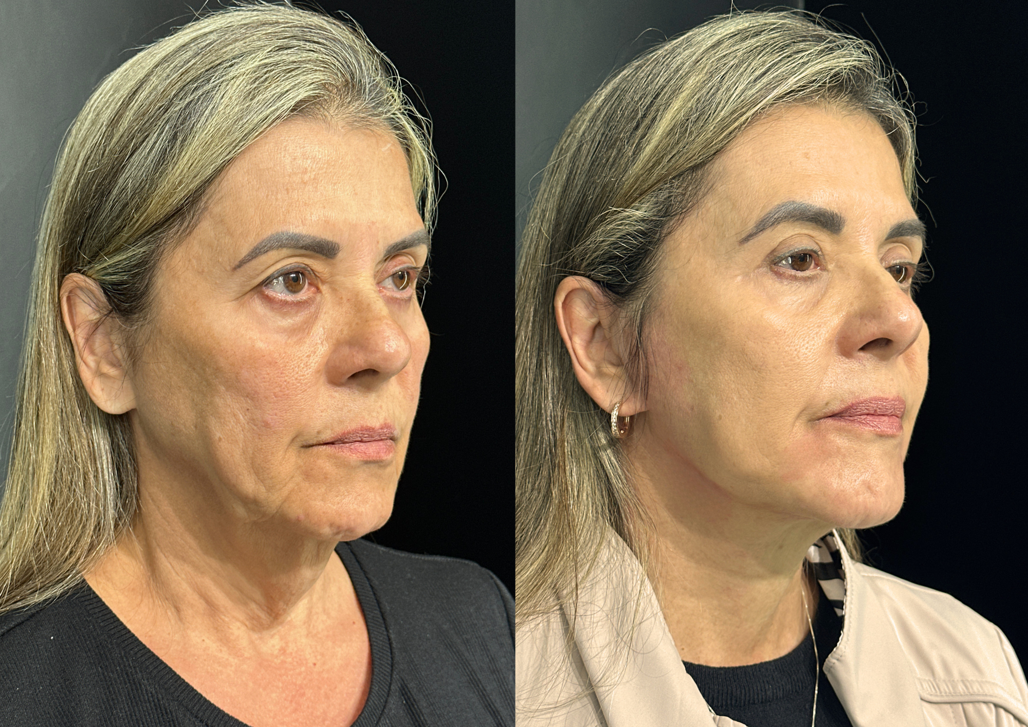 Antes e depois — Perfil direito