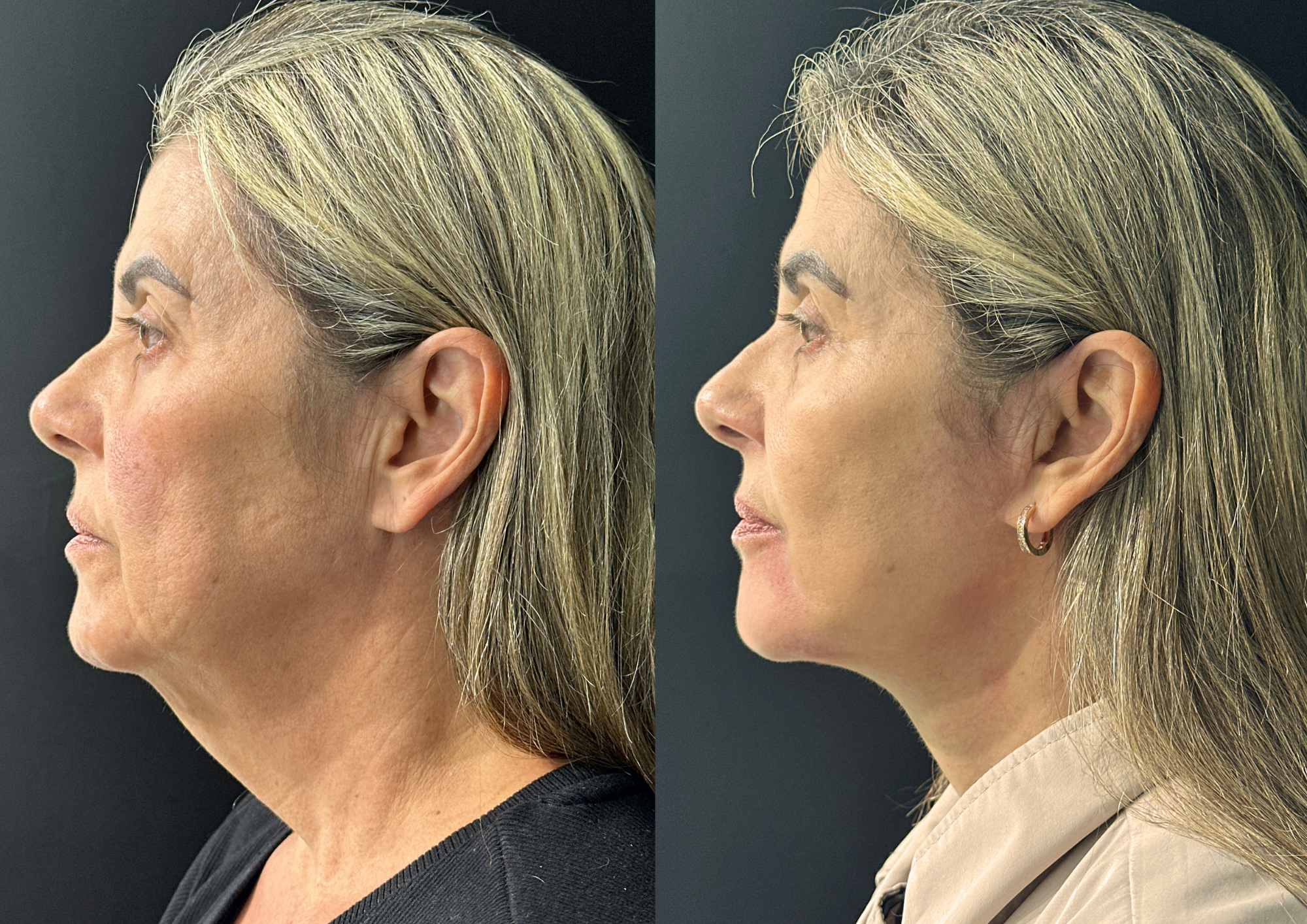 Antes e depois — Perfil esquerdo
