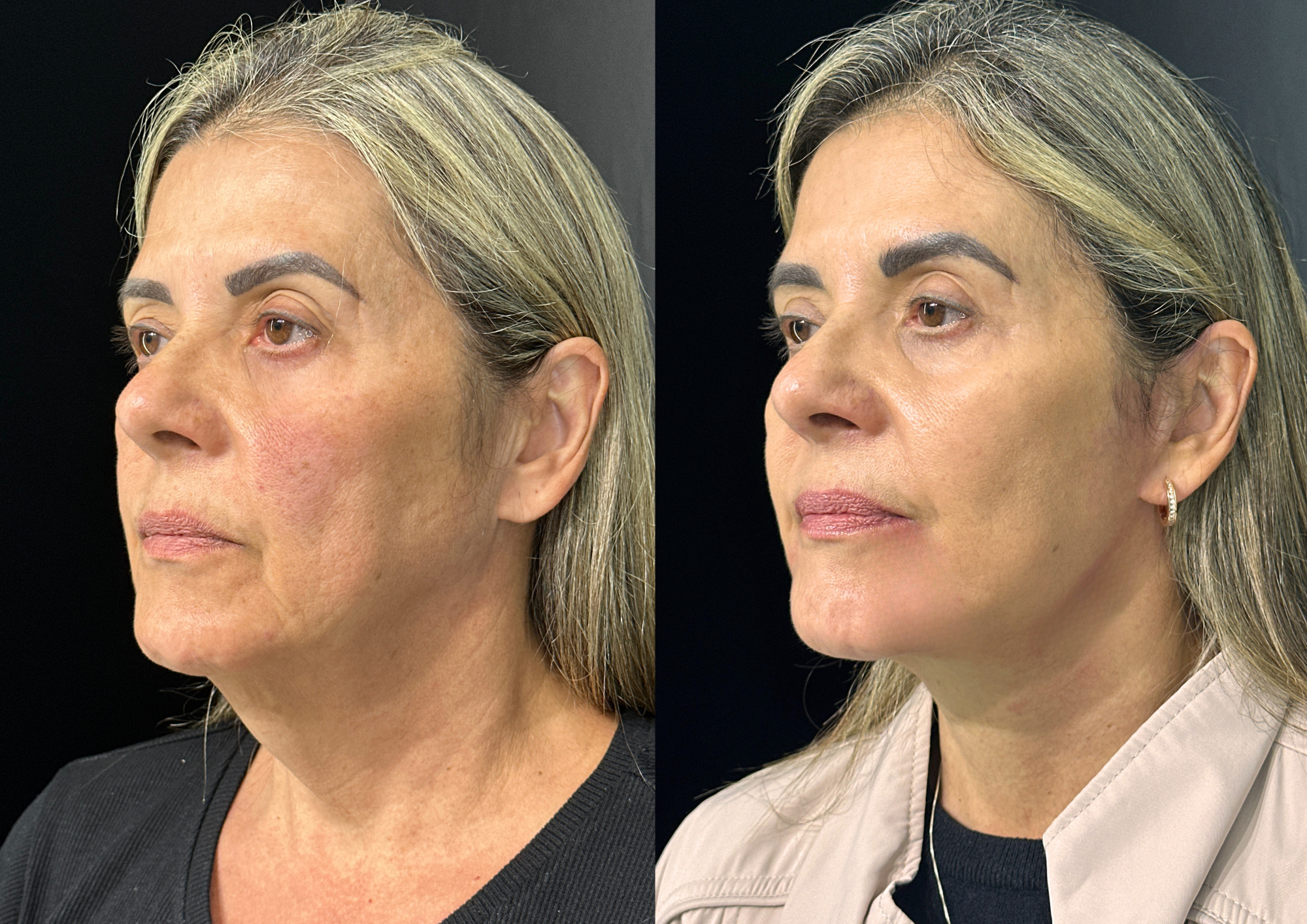 Antes e depois — 45° direita