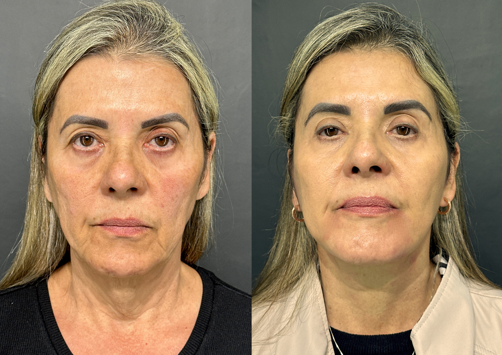 Antes e depois — 45° esquerda