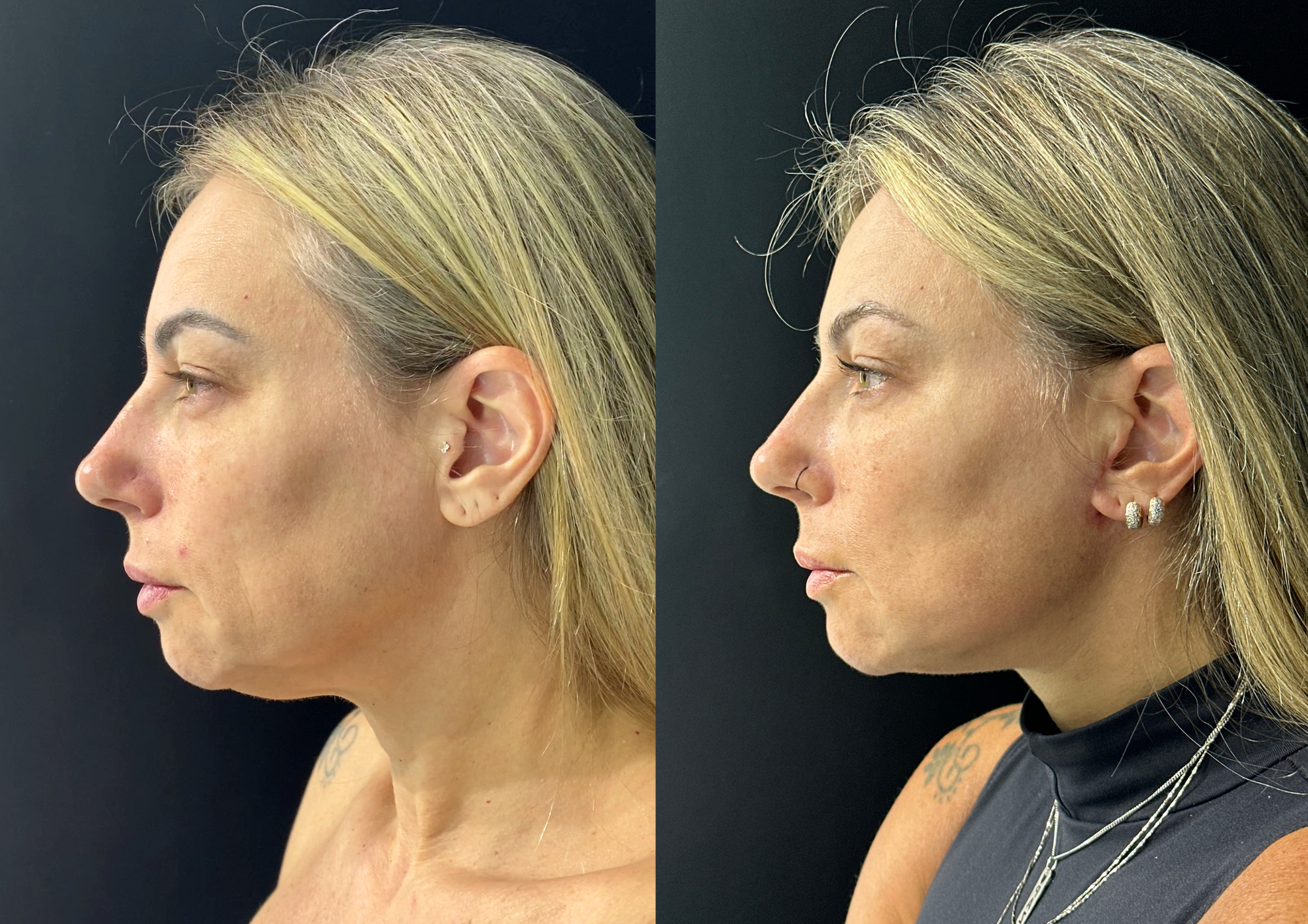 Antes e depois — Perfil direito