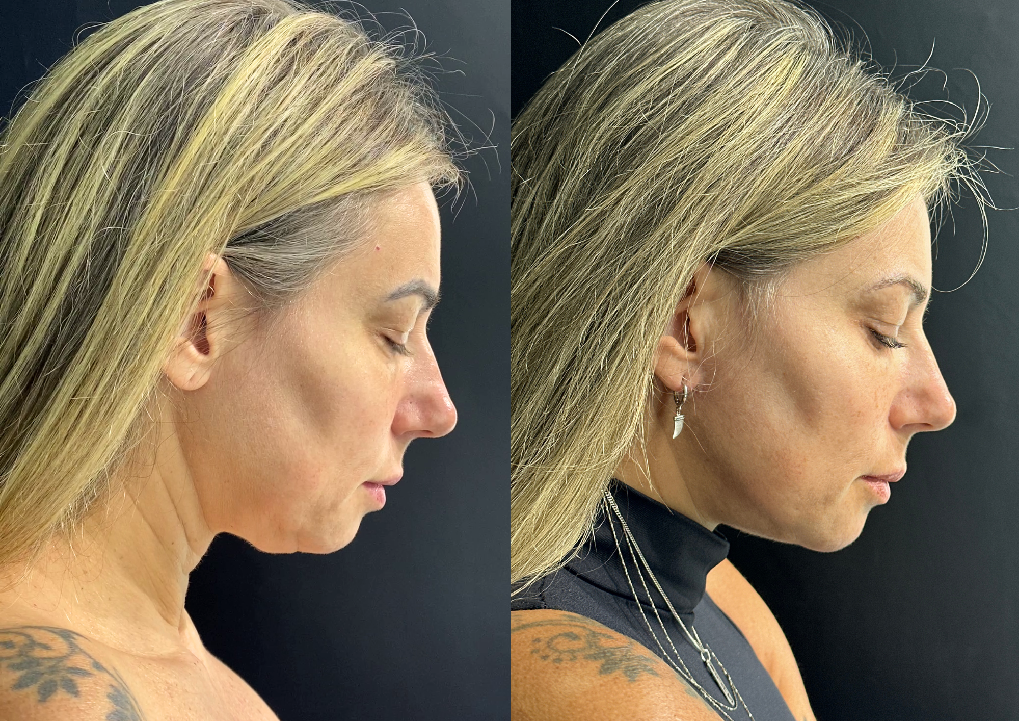 Antes e depois — Perfil esquerdo