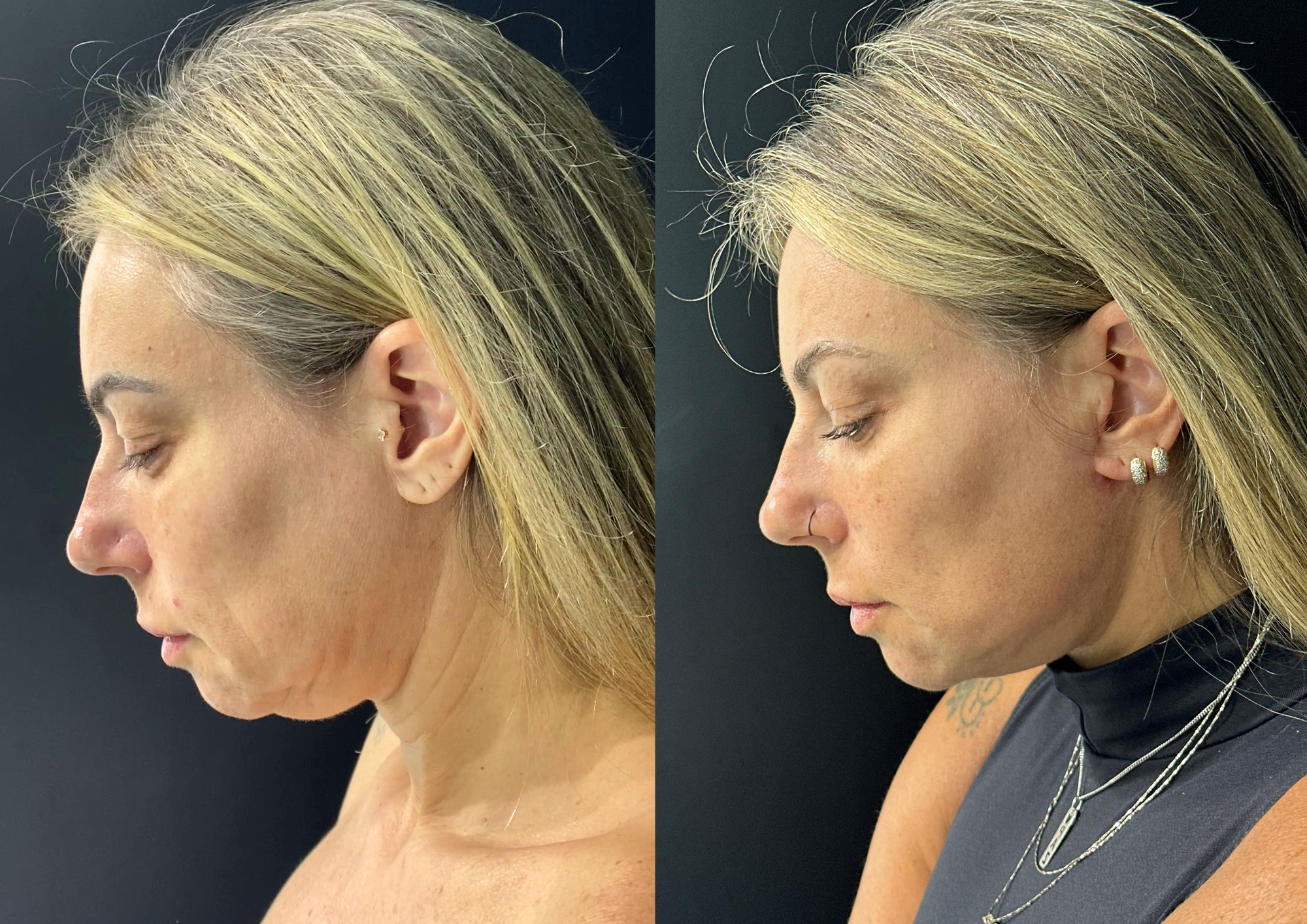 Antes e depois — 45° direita