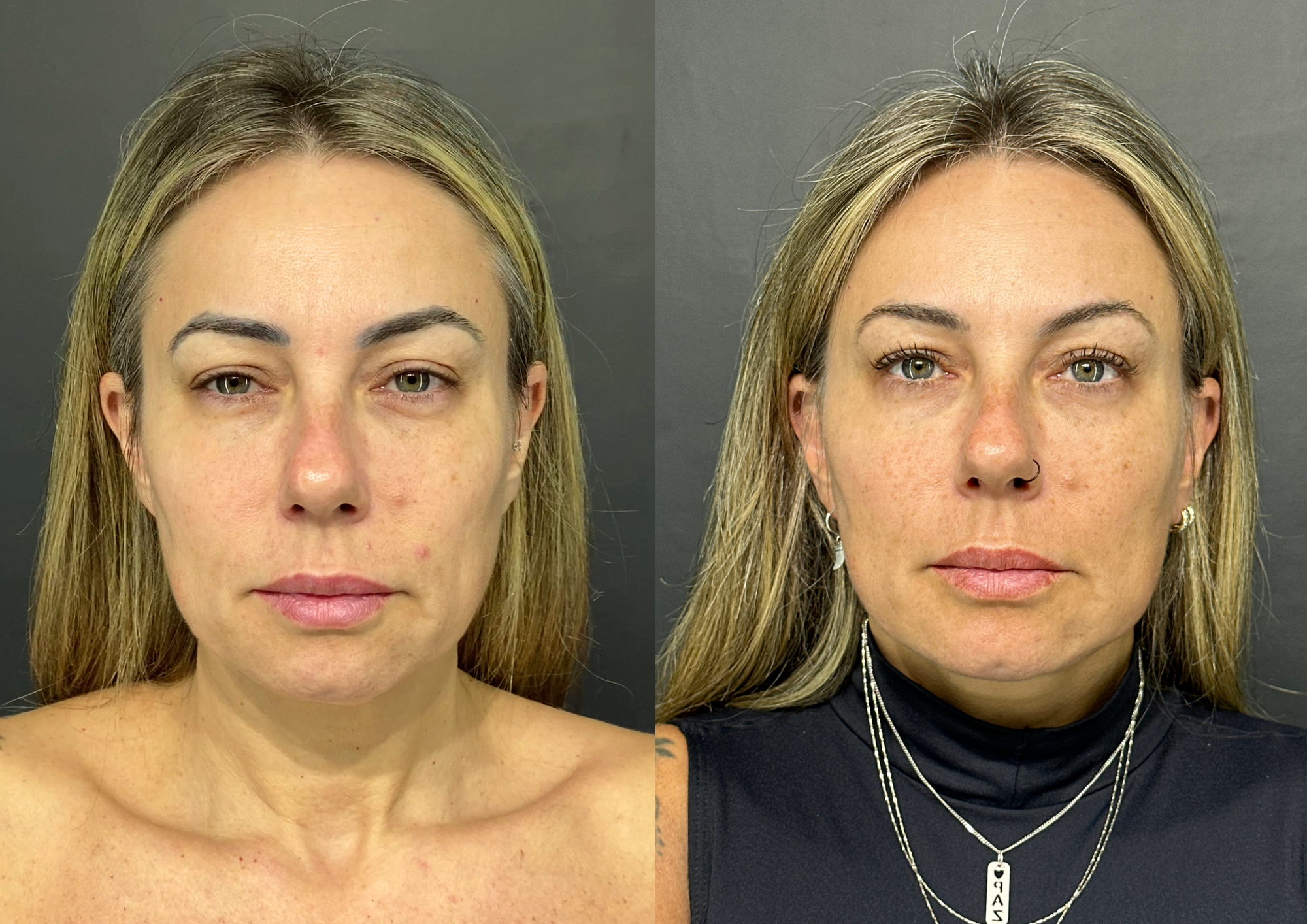 Antes e depois — 45° esquerda
